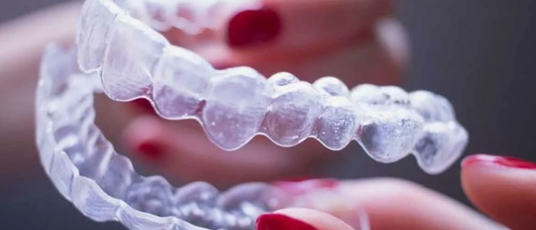 Сколько стоит лечение элайнерами и от чего зависит цена?